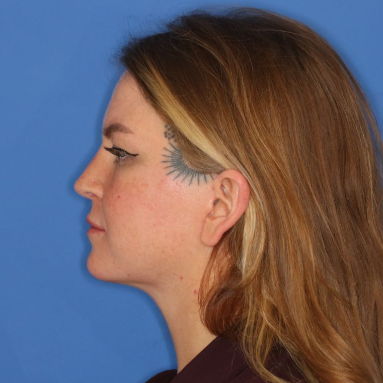 65 year old female underwent deep plane face and neck lift in Leawood, KS