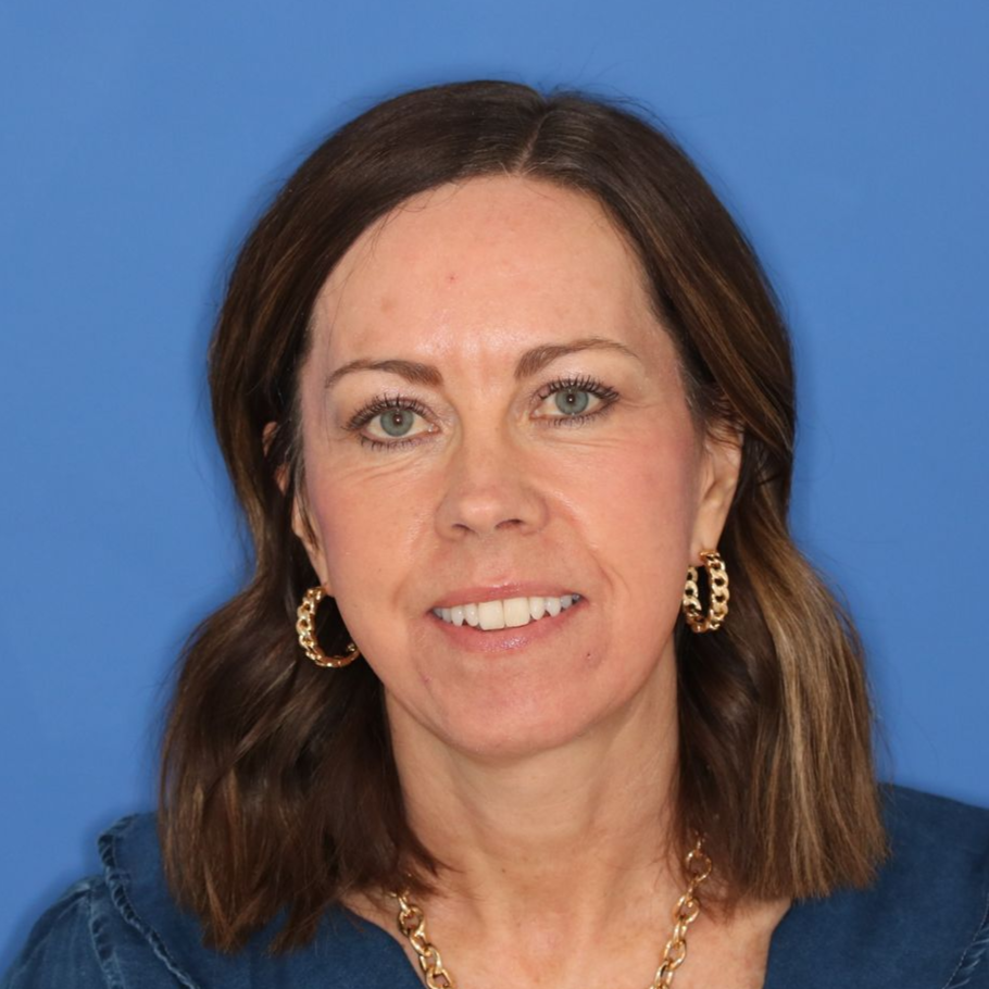 Woman posing in front of a blue background after a facelift