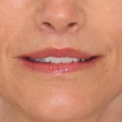 55 year old female underwent deep plane face and neck lift posing on a blue background