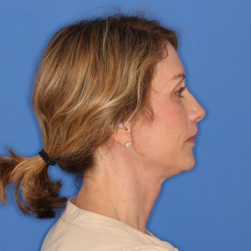 55 year old female posing for an after photo on a blue background