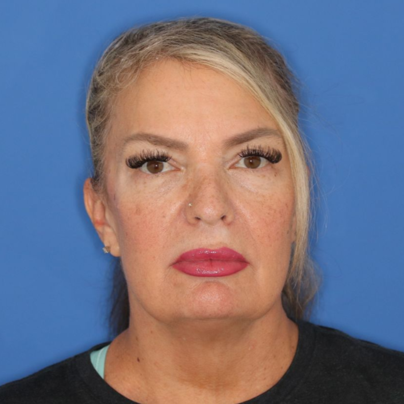 55 year old female posing before undergoing deep plane facelift, deep neck lift, upper blepharoplasty and lower blepharoplasty at Carson Williams Facial Plastic Surgery