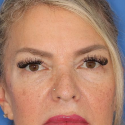 55 year old female posing before undergoing deep plane facelift, deep neck lift, upper blepharoplasty and lower blepharoplasty at Carson Williams Facial Plastic Surgery
