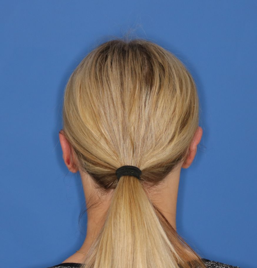 17 year old girl after receiving an otoplasty