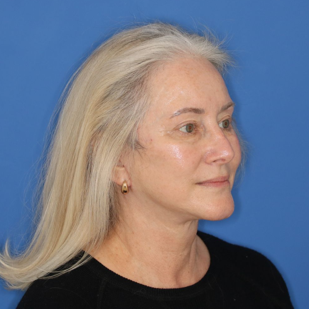 Woman facing to the right posing for a photo after receiving a facelift