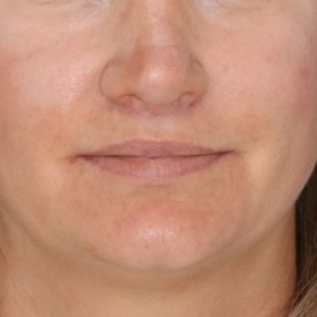 Close up of a woman's face after receiving a lip lift
