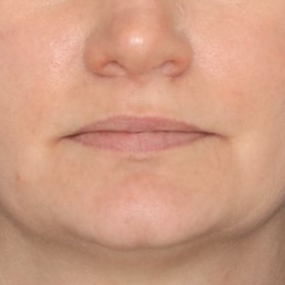 Close up of a woman's lips before receiving a lip lift surgery