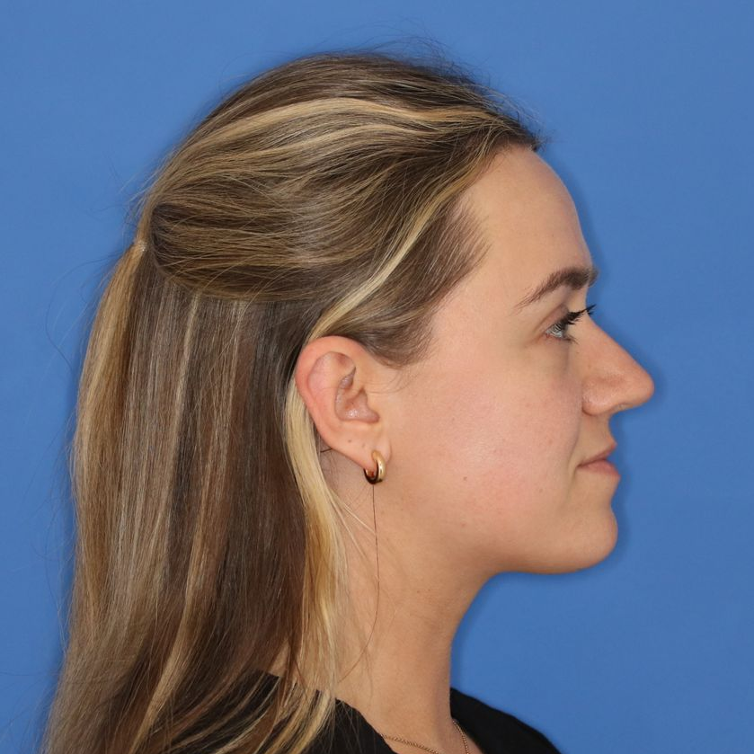 Side profile of a blonde woman's face before a rhinoplasty