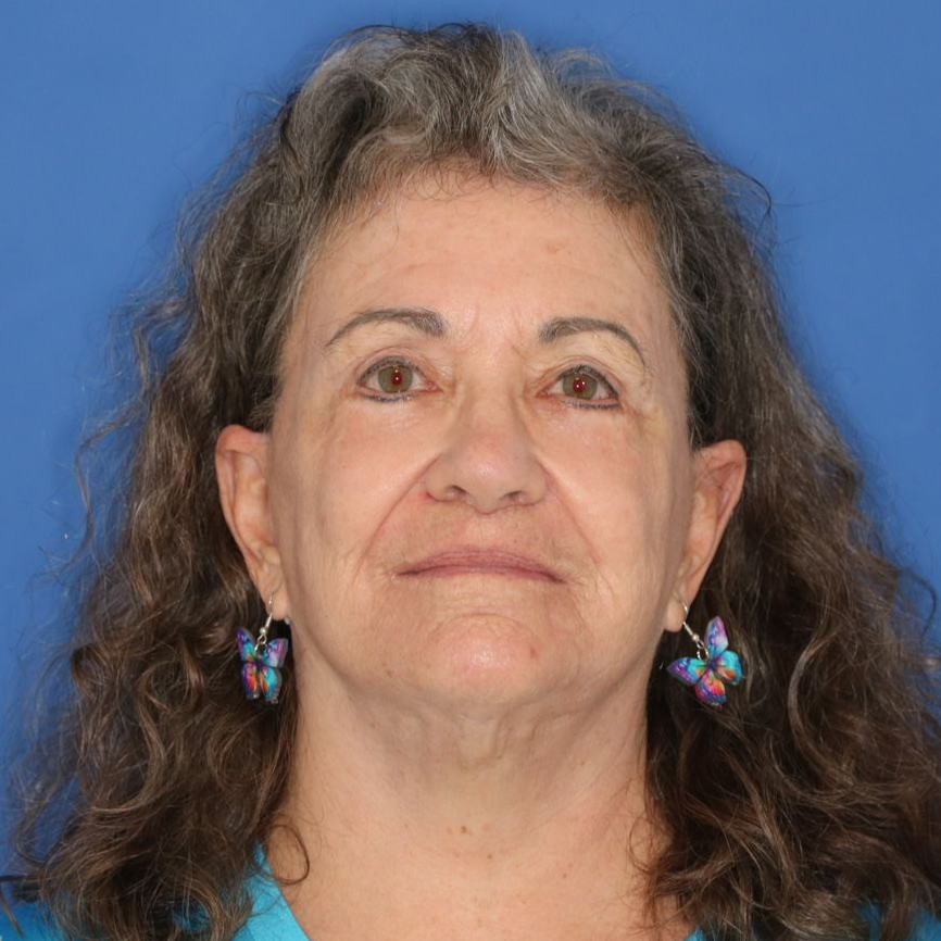 69 year old female after surgery posing on a blue background