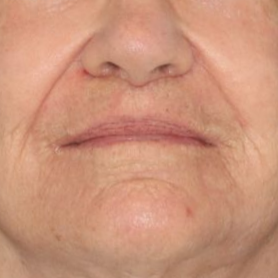 69 year old female after surgery posing on a blue background