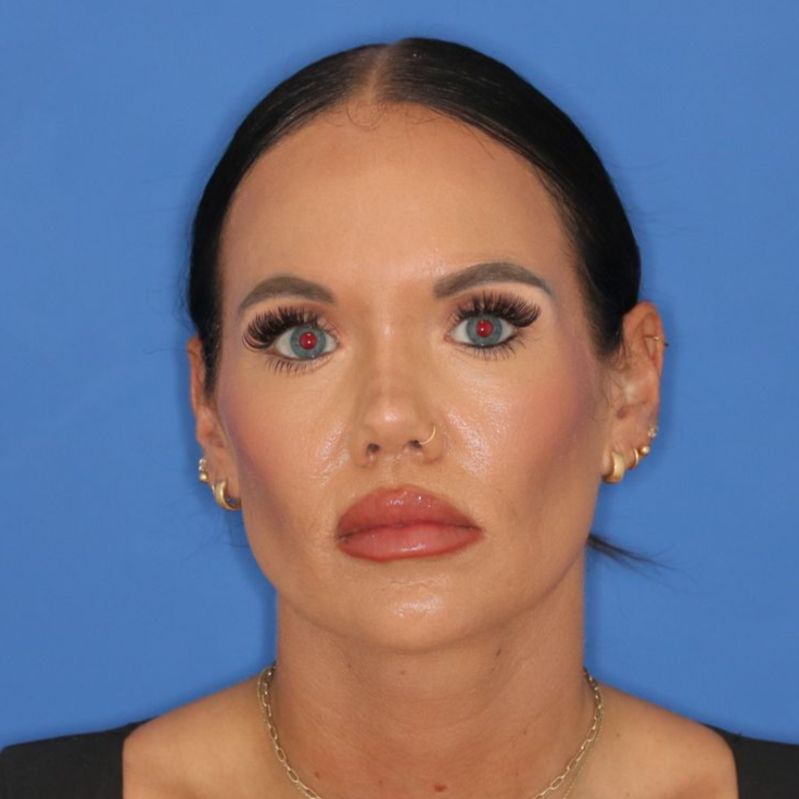38 year old female before undergoing cosmetic rhinoplasty posing on a blue background