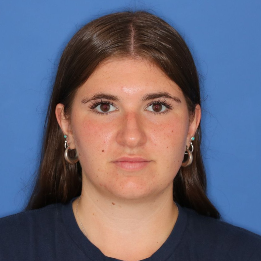 25 year old female before undergoing cosmetic rhinoplasty posing on a blue background