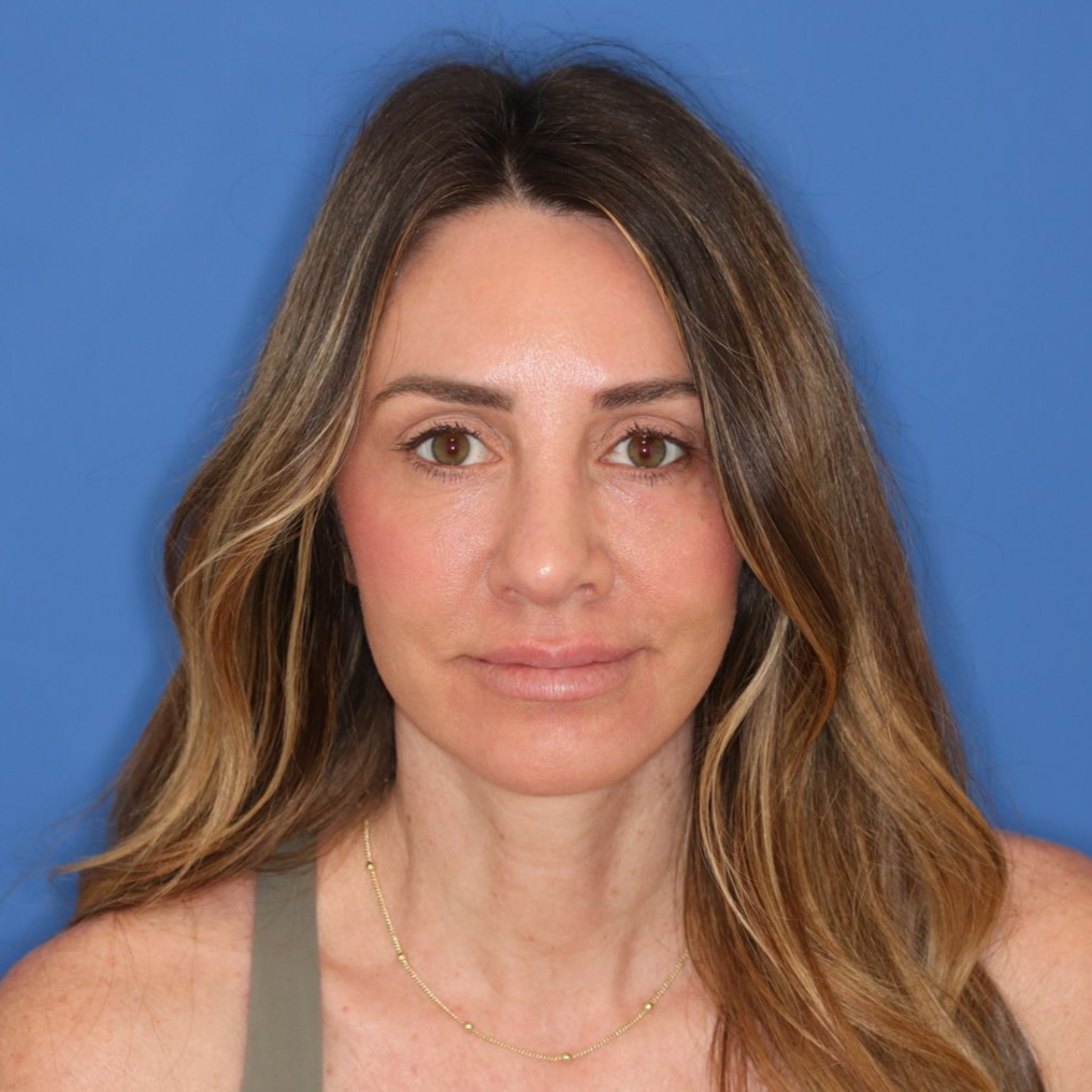 Woman posing in front of a blue background after CO2 laser treatment