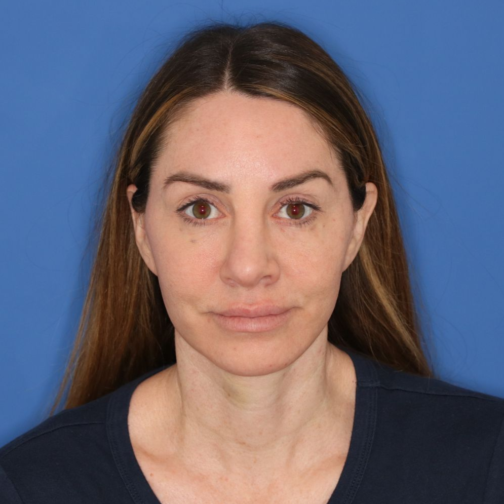 Woman posing in front of a blue background before CO2 laser treatment