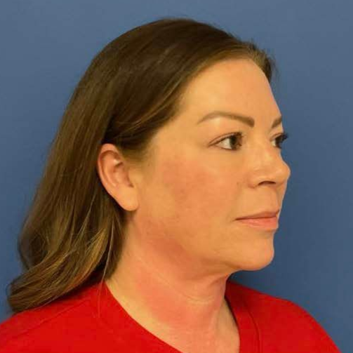 43 year old female facing to the right in front of a blue background before surgery