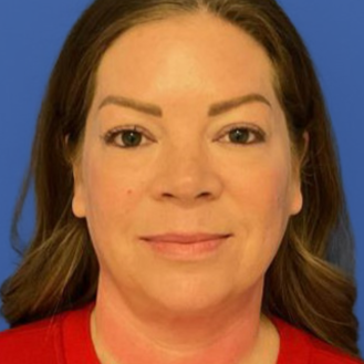 43 year old female underwent a lip lift posing for a before photo