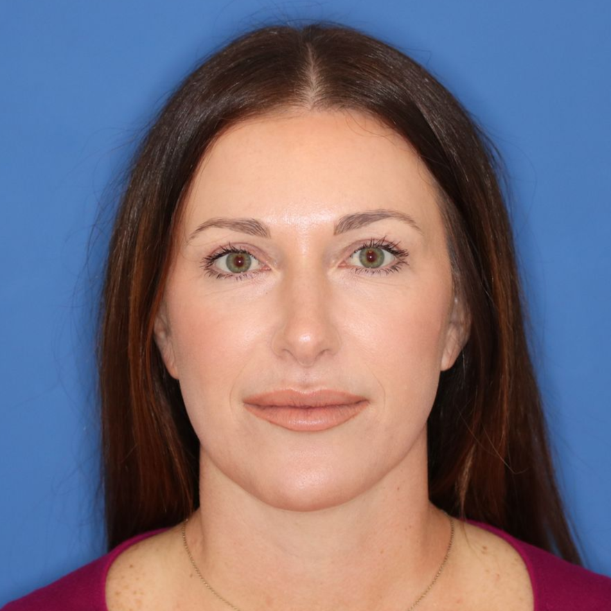 A woman facing forward posing for a photo after receiving a blepharoplasty.