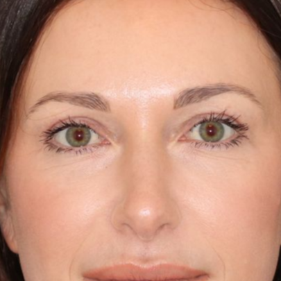 A woman facing forward posing for a photo after receiving a blepharoplasty.