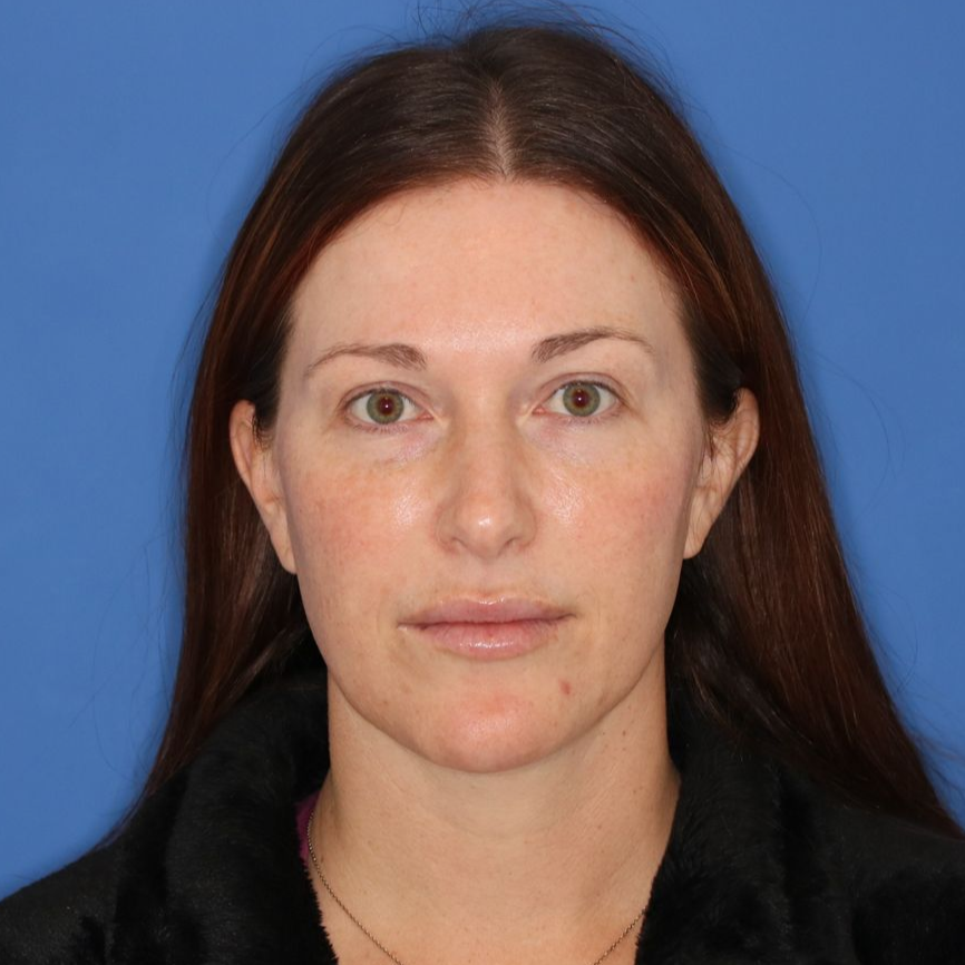 A woman facing forward posing for a photo before receiving a blepharoplasty.