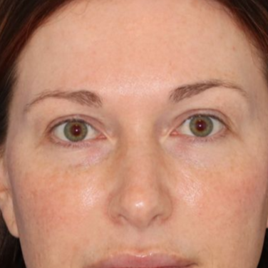 A woman facing forward posing for a photo before receiving a blepharoplasty.