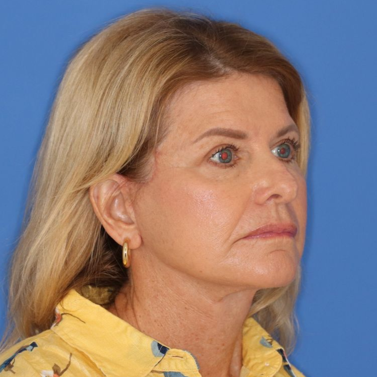 Close up of a woman after Facelift surgery at Carson Williams Facial Plastic Surgery in Leawood, KS