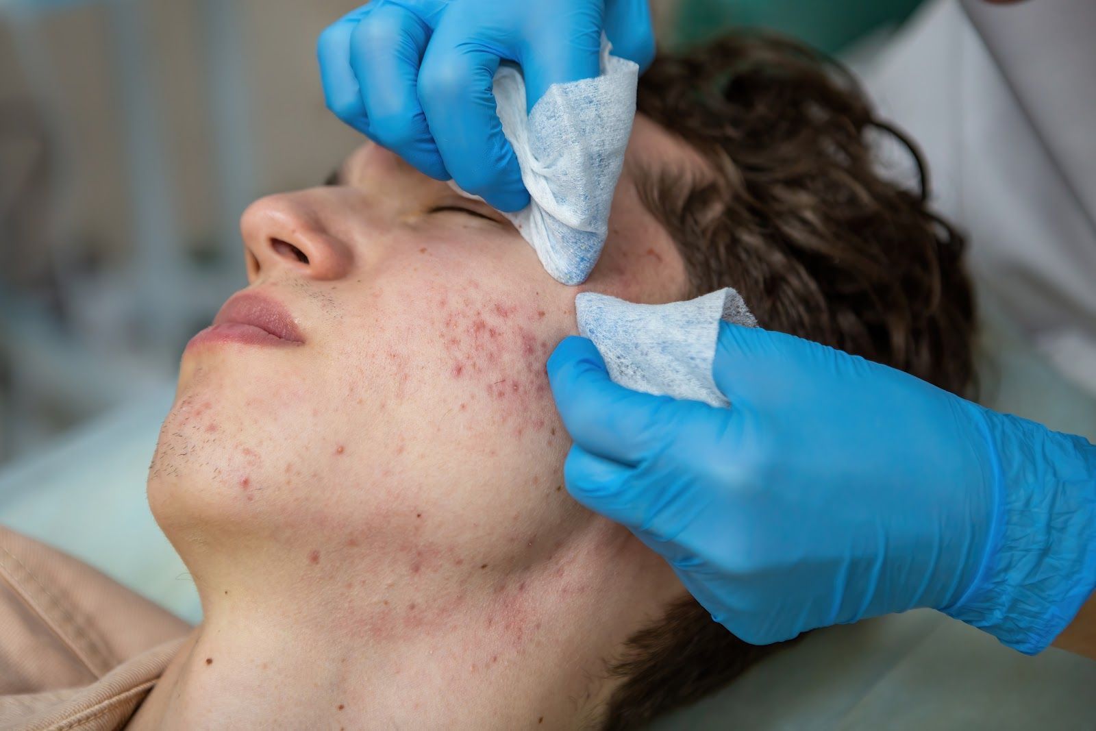 Gloved hands wiping a young person's acne-prone face with gauze in a clinical setting