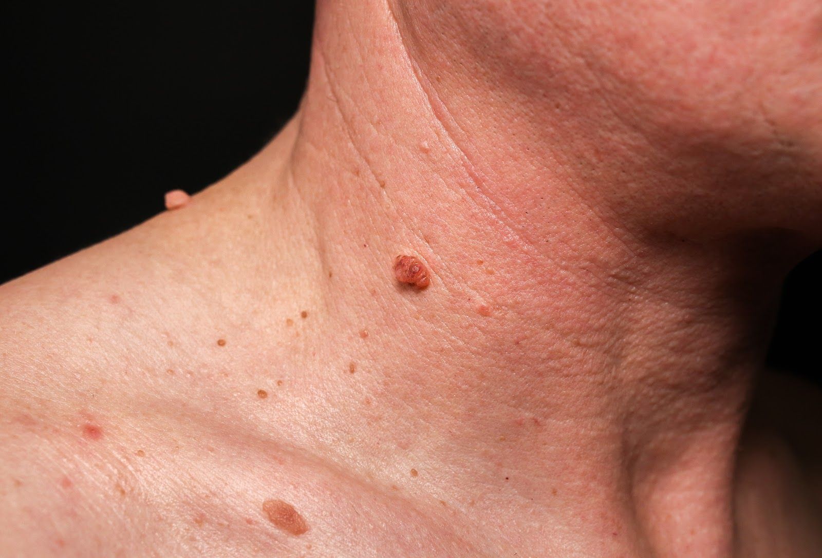 Close-up of a neck and shoulder with a small raised brown skin mole