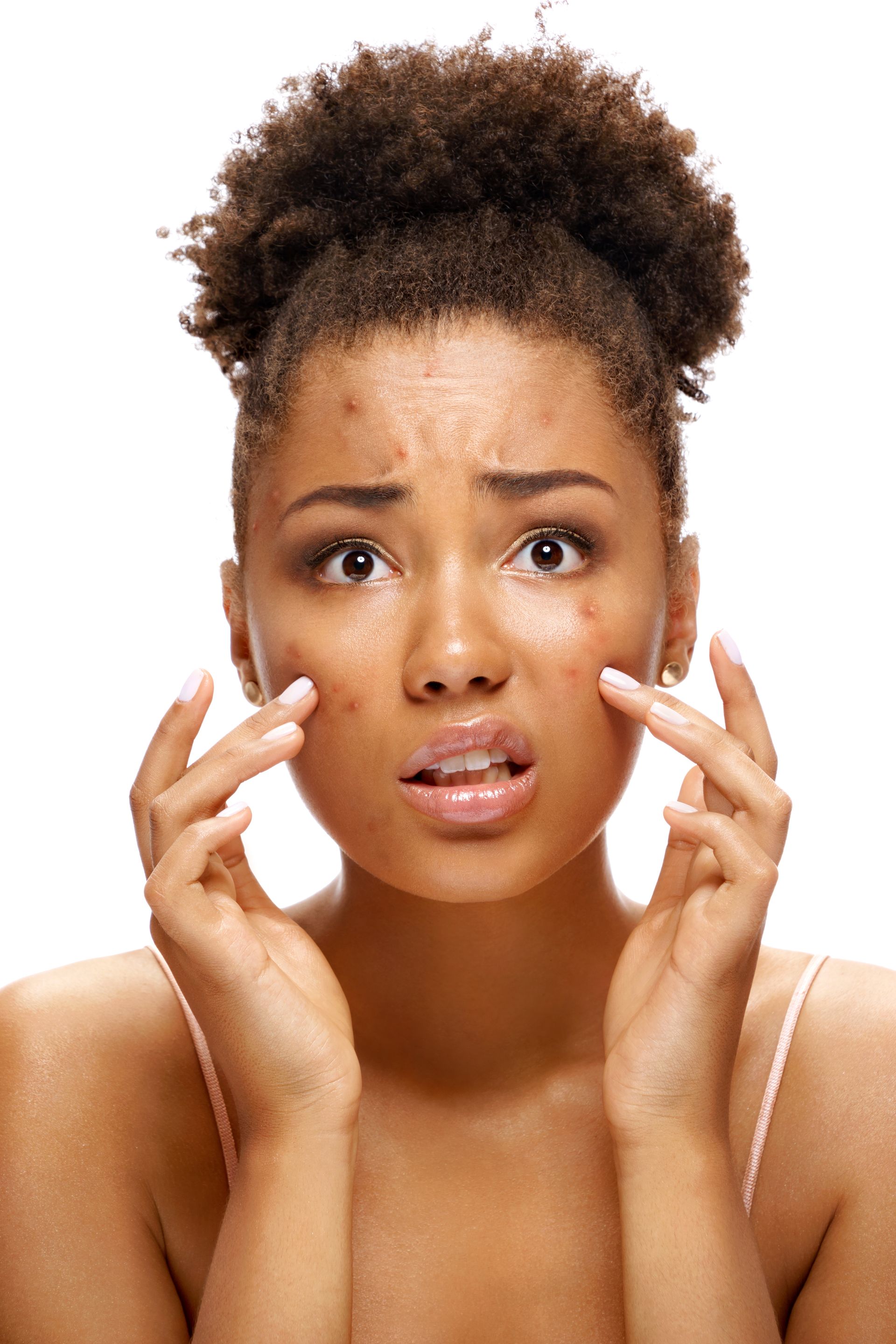 Young Black woman with acne, wide-eyed, touching cheeks with concerned expression.
