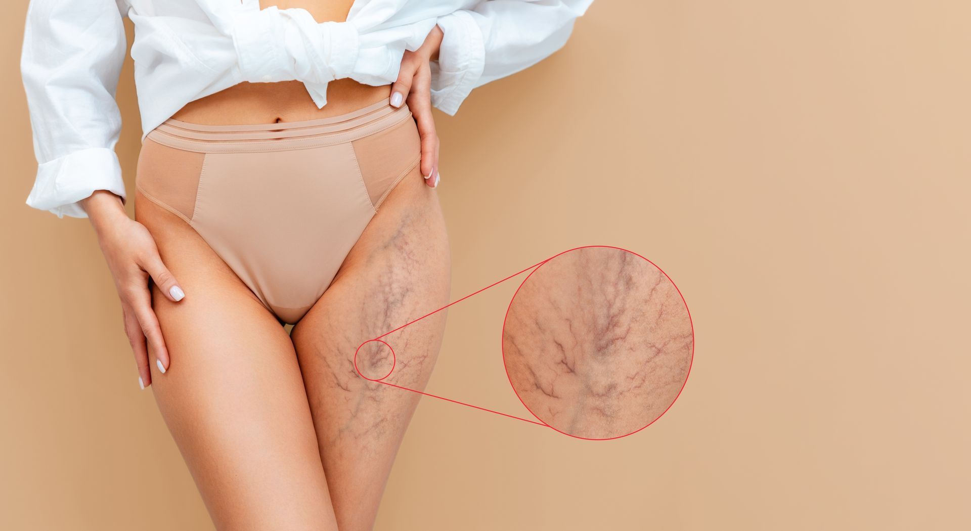 Woman's thigh with visible varicose veins; beige background, wearing underwear and a white shirt.