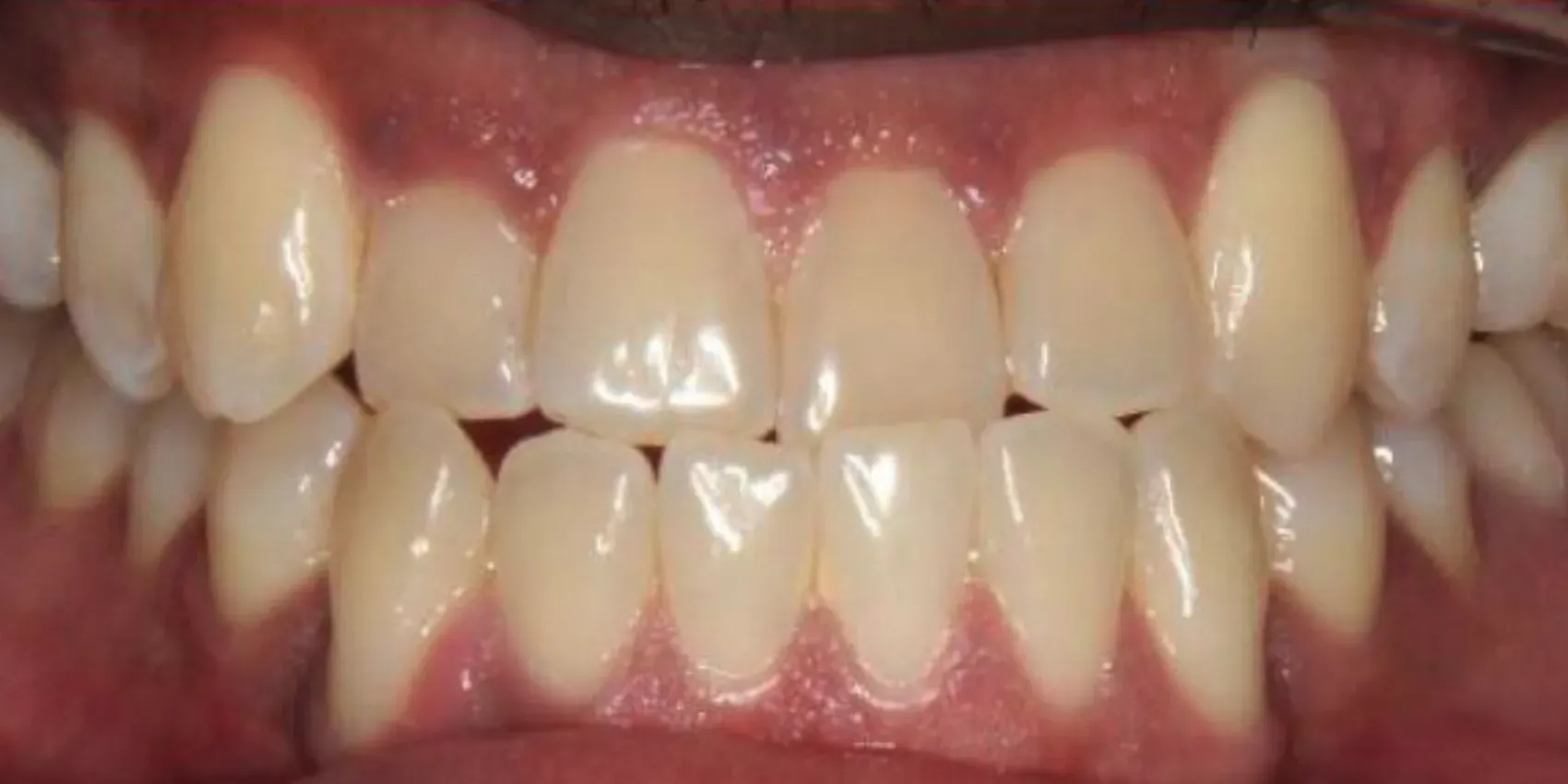 A close up of a person 's teeth with white teeth.