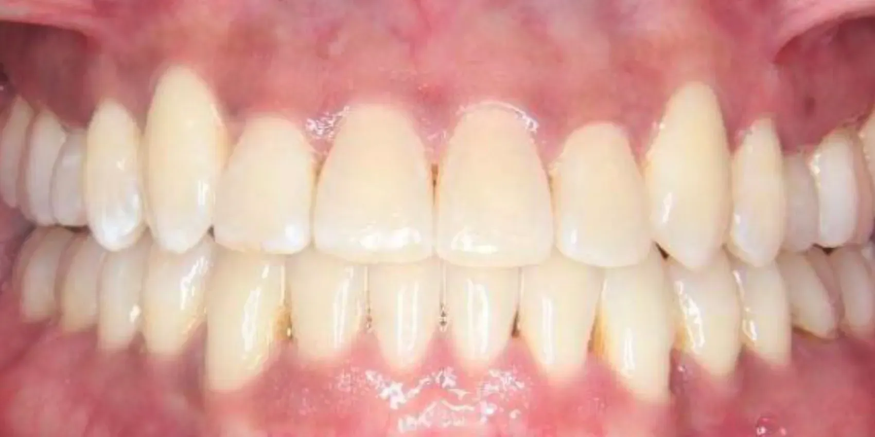 A close up of a person 's teeth with white teeth.