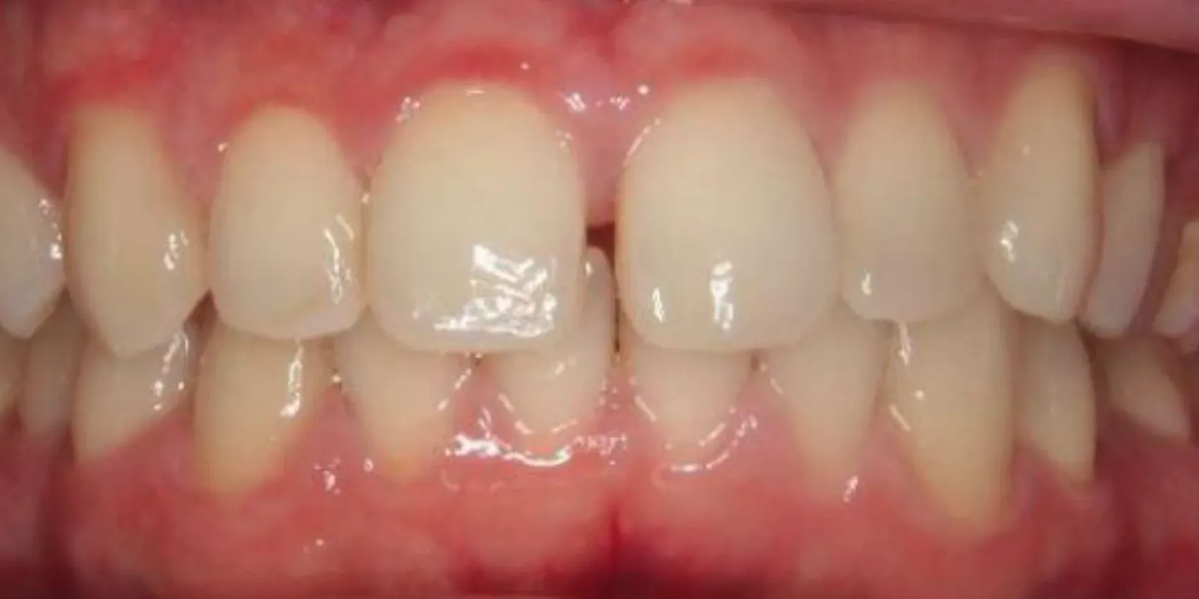 A close up of a person 's teeth with white teeth and red gums.