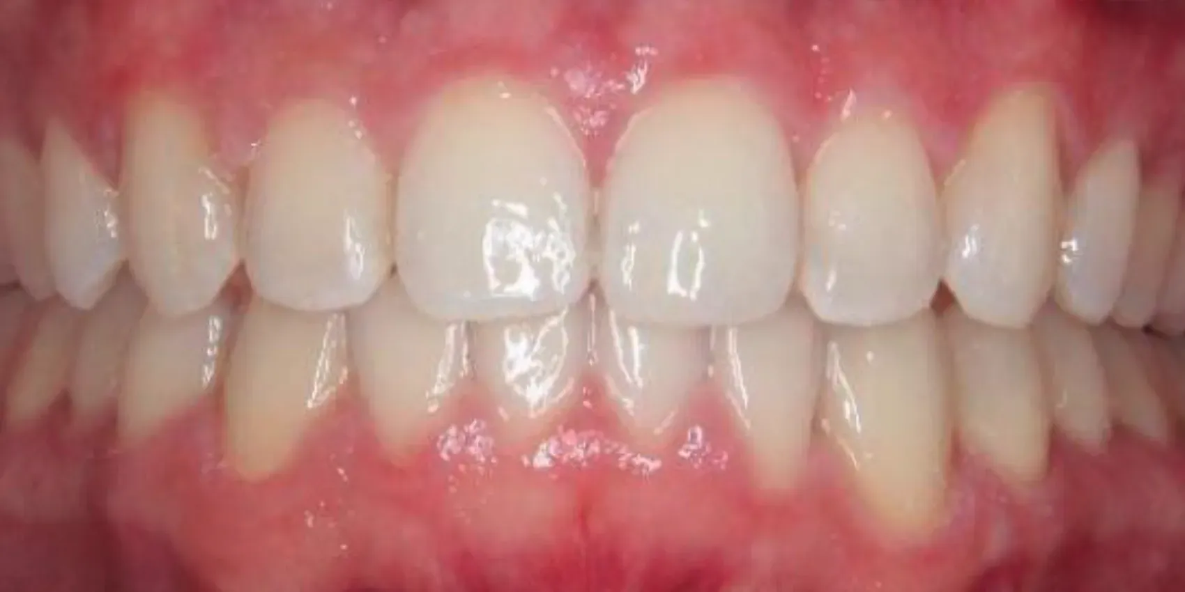 A close up of a person 's teeth with white teeth and red gums.