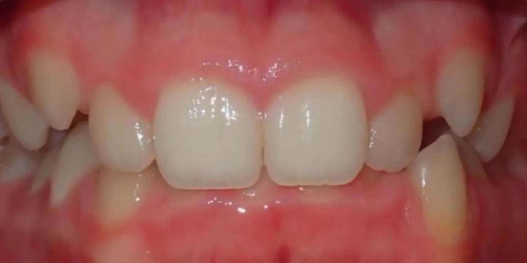 A close up of a person 's teeth with a broken tooth.