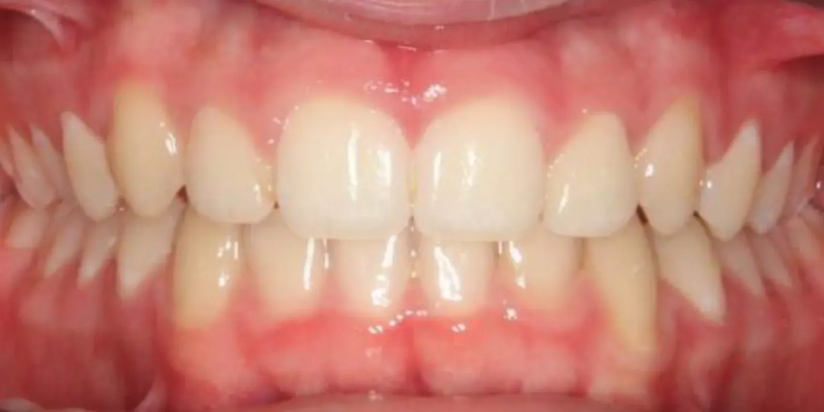 A close up of a person 's teeth with white teeth and red gums.