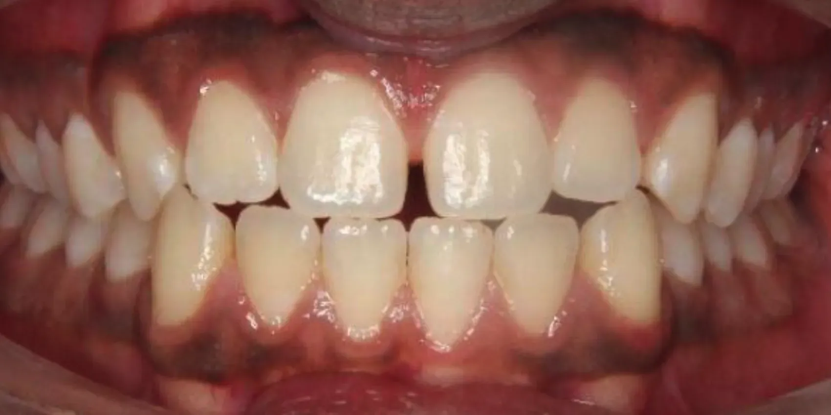 A close up of a person 's teeth with red gums.