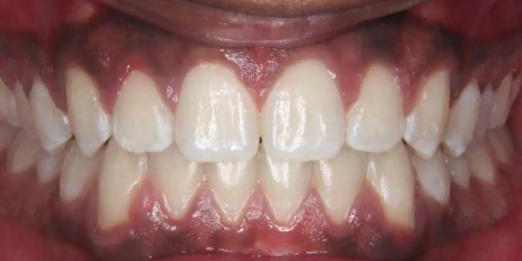 A close up of a person 's teeth with white teeth.