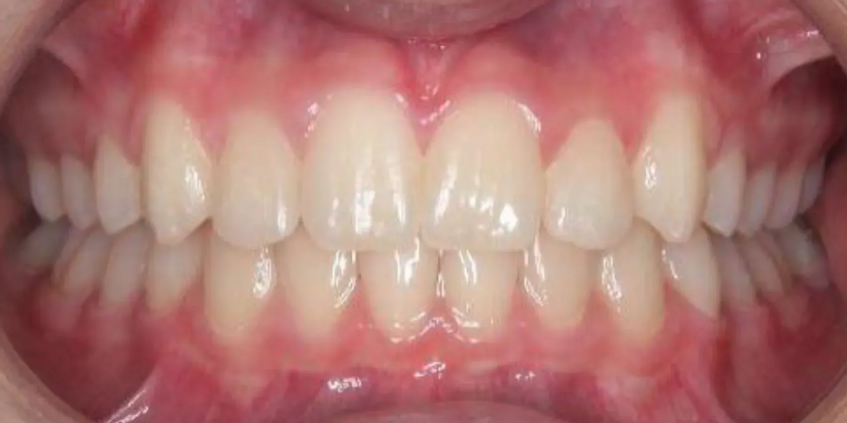 A close up of a person 's teeth with white teeth.