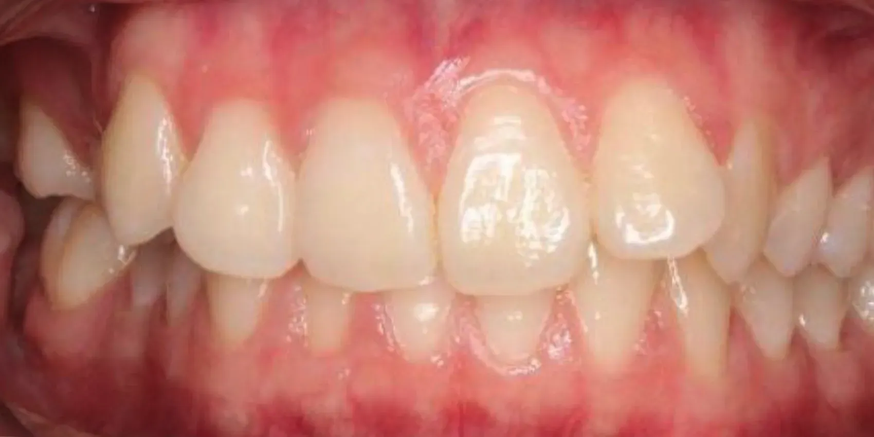 A close up of a person 's teeth with white teeth.