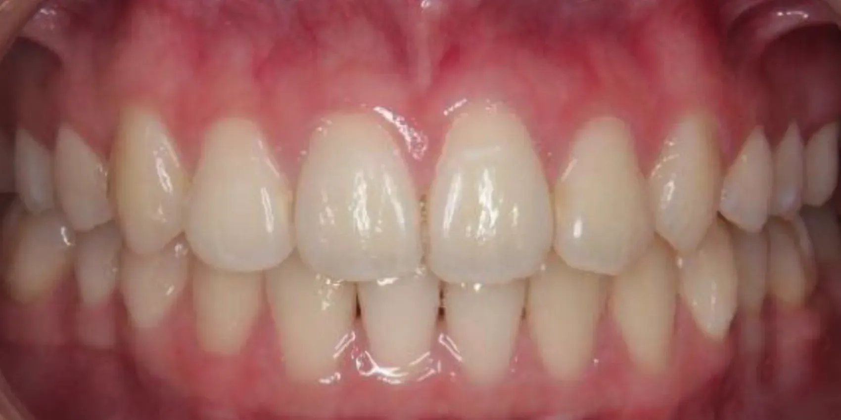 A close up of a person 's teeth with white teeth.
