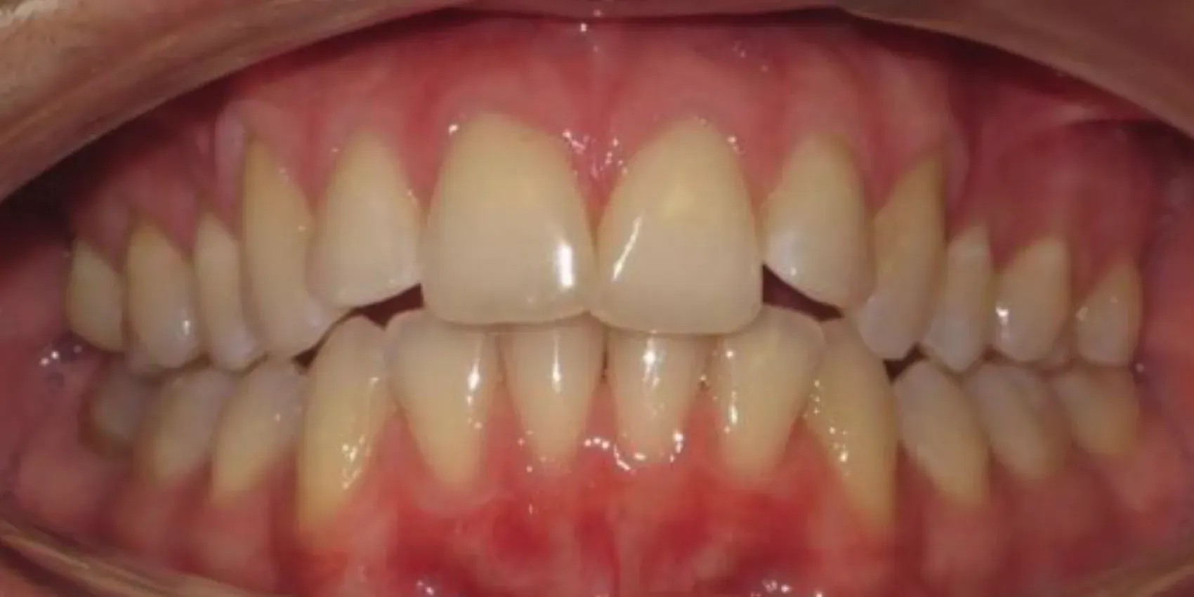 A close up of a person 's teeth with a broken tooth.
