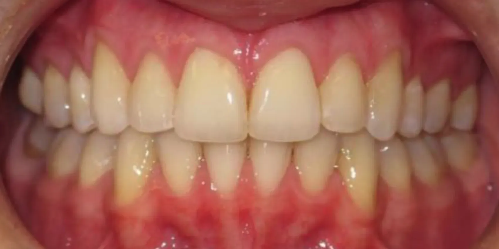 A close up of a person 's teeth with white teeth.