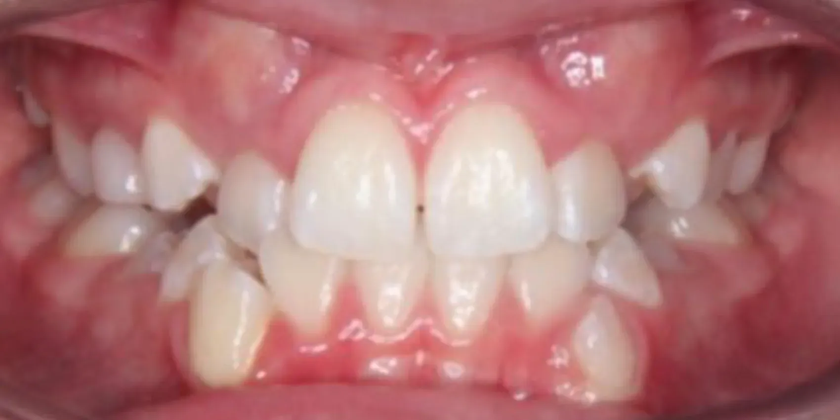 A close up of a person 's teeth and gums