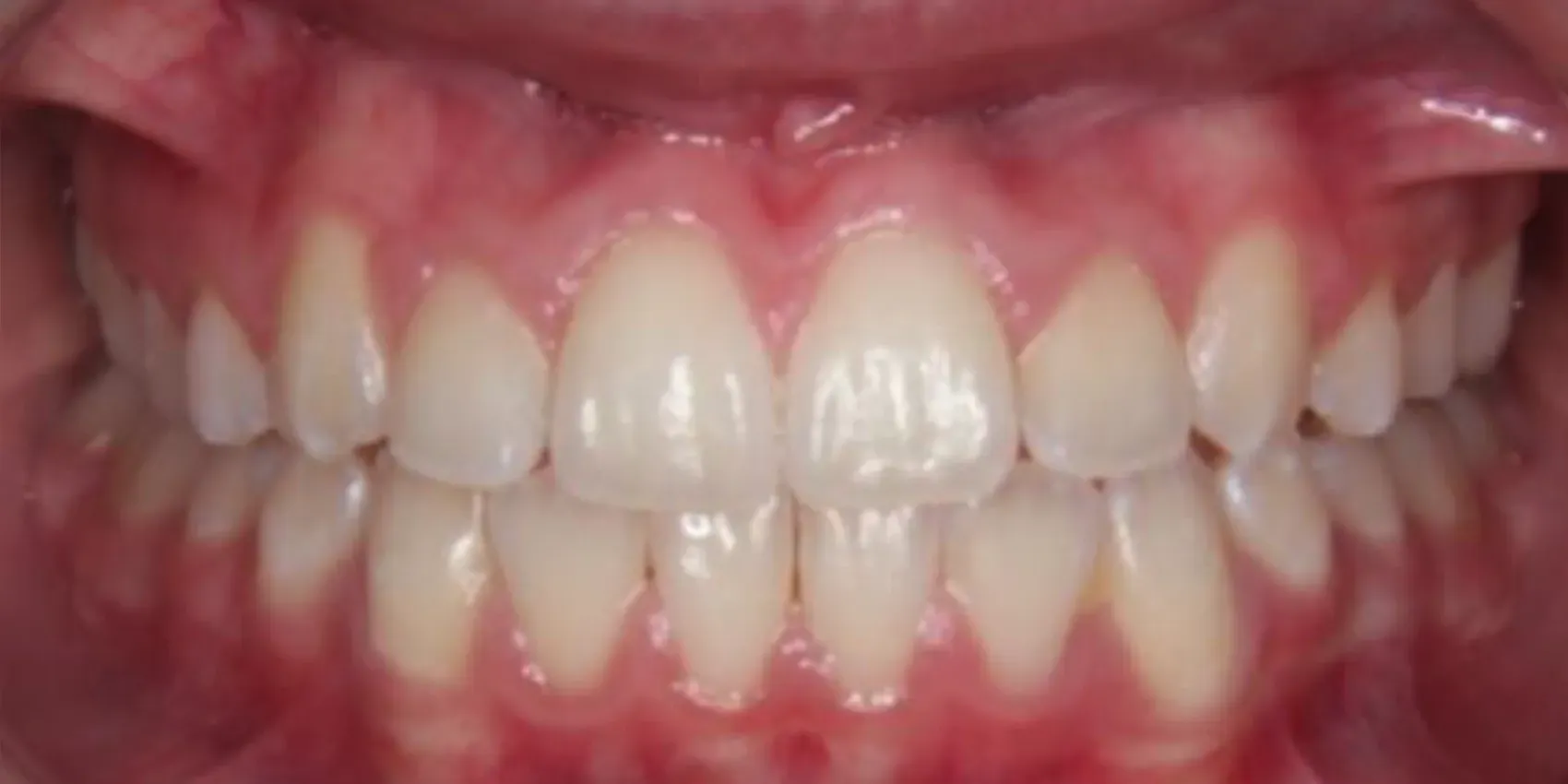 A close up of a person 's teeth with red gums.