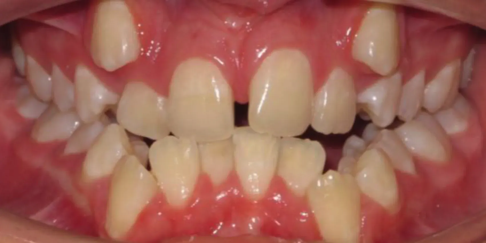 A close up of a person 's teeth with a few missing