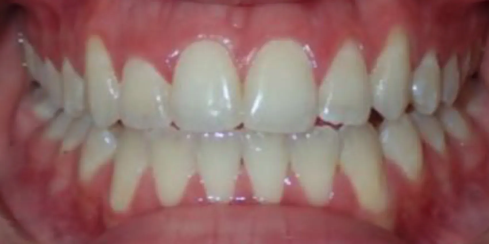 A close up of a person 's teeth with a broken tooth.