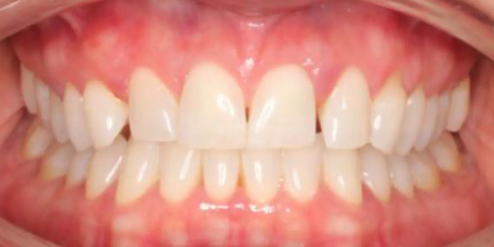 A close up of a person 's teeth with white teeth.