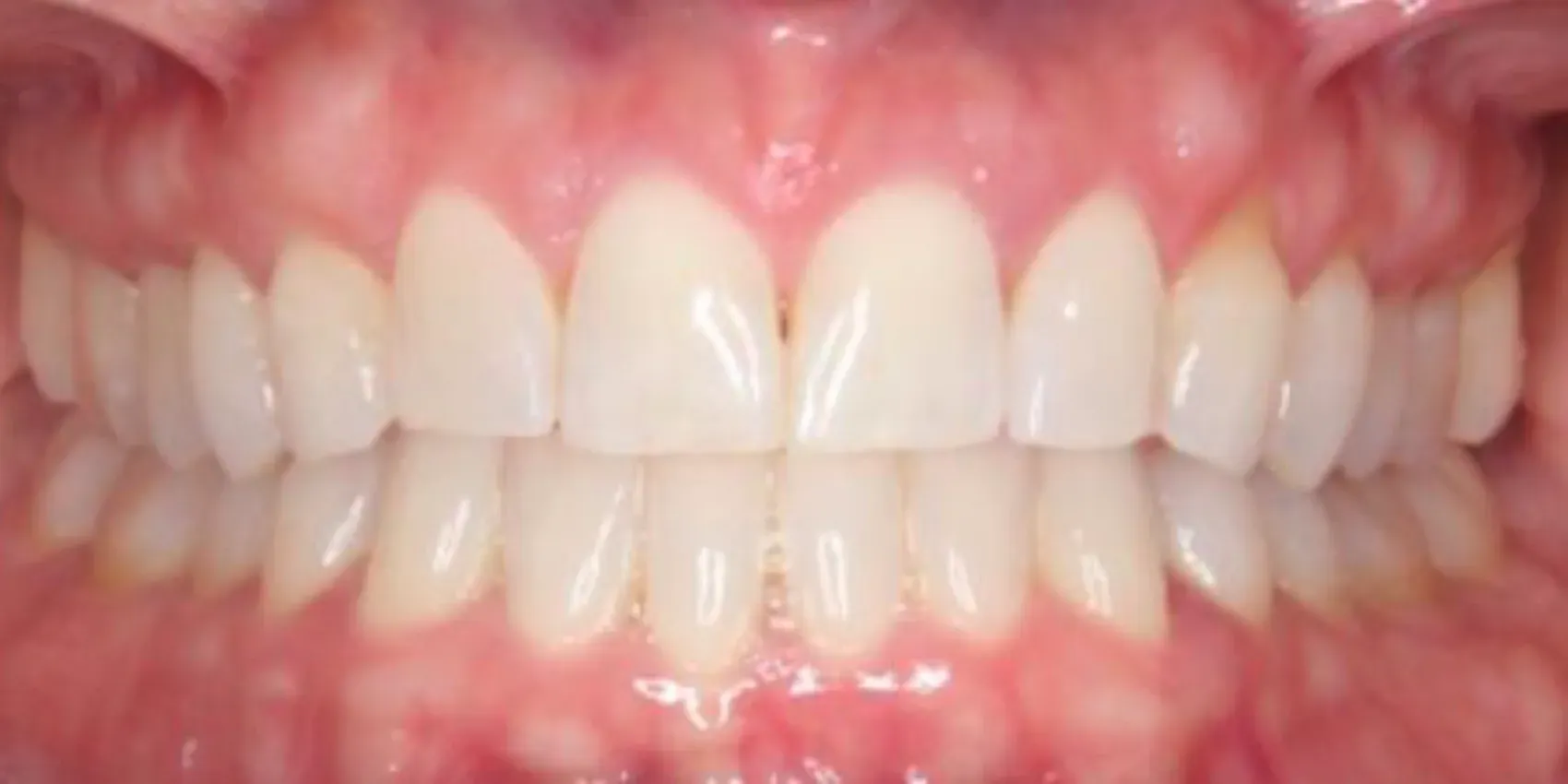 A close up of a person 's teeth with white teeth.
