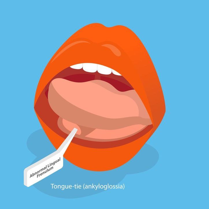 An isometric illustration of a woman 's mouth with a tongue tie