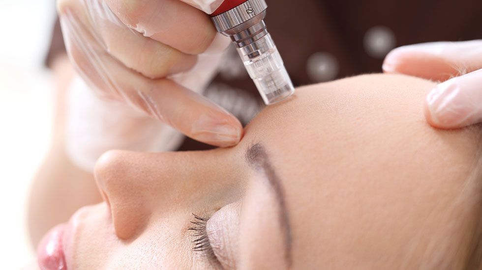 A woman is getting a microneedle treatment on her forehead.