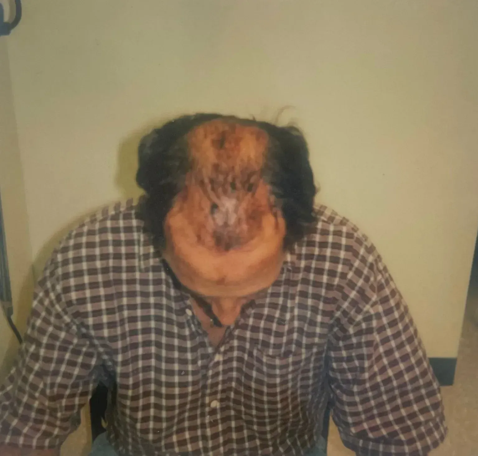 Hair Transplants Before and After